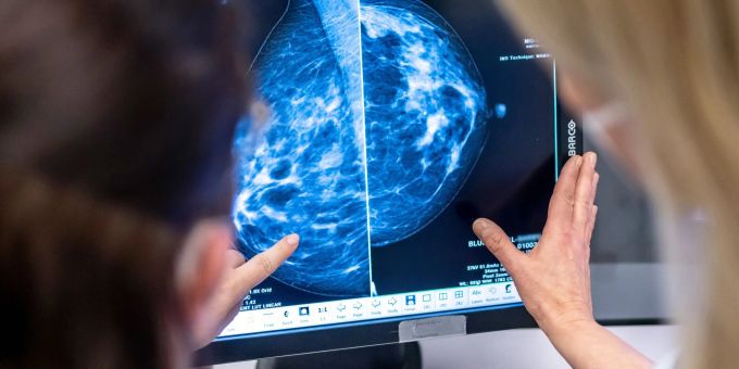 Anastrozol - Medikament könnte Brustkrebsrate in UK um Hälfte senken