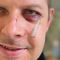 Verprügelter SPD-Mann Matthias Ecke zeigt sich auf Social-Media